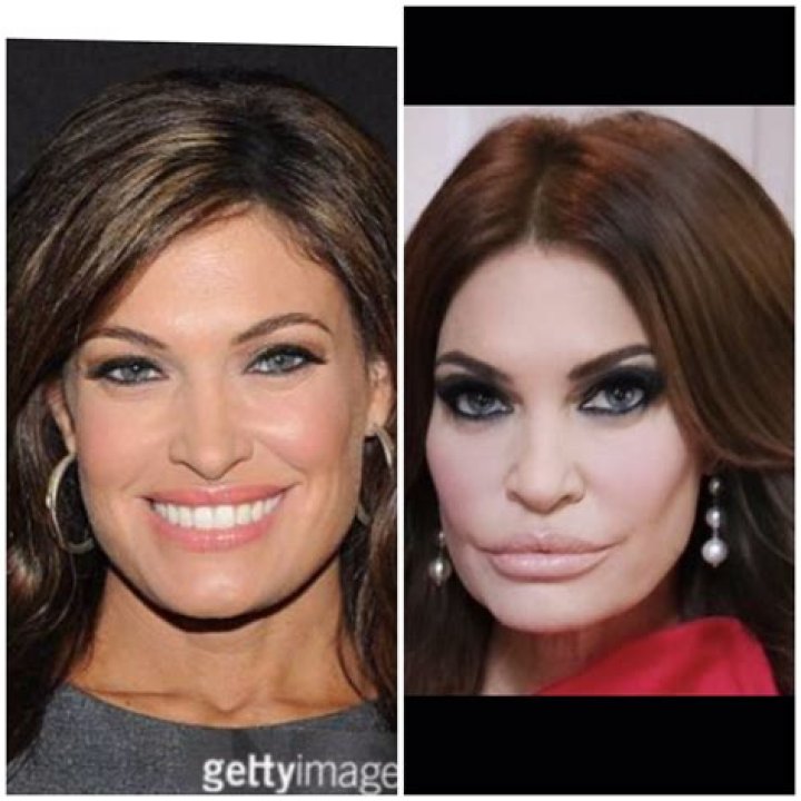 How Much Plastic Surgery Has Kimberly Guilfoyle Had?