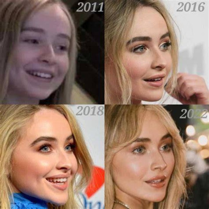 Sabrina Carpenter Nose Surgery Transformation And Controversy