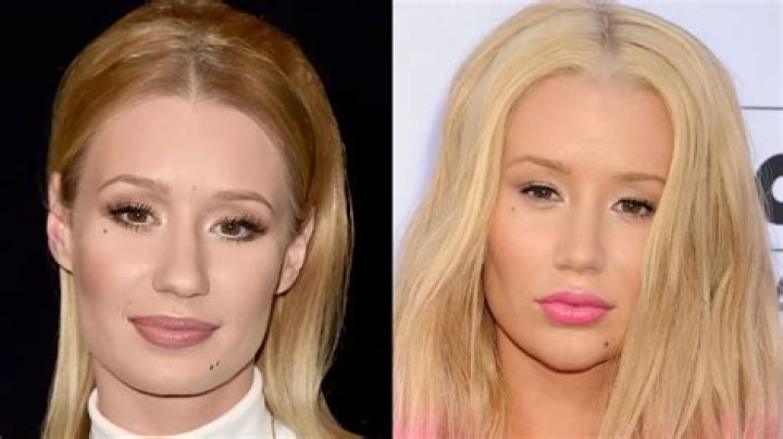 When Iggy Azalea split from rapper A$AP Rocky, she deemed laser removal a little too fancy for her tastes.